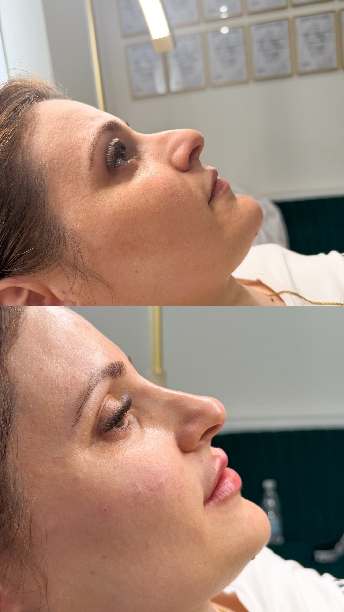 Resultado de tratamento facial