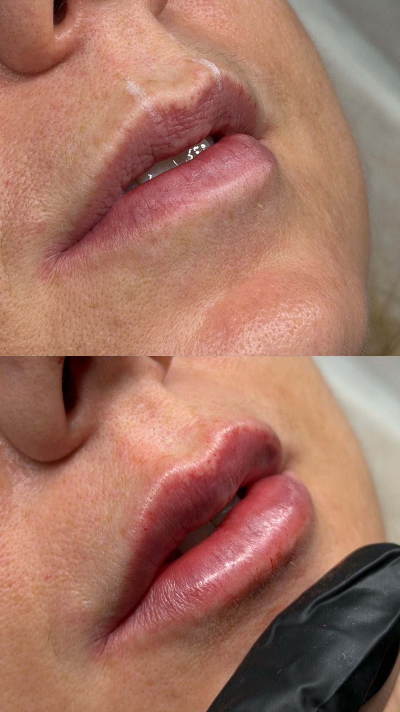 Antes e depois de lábios