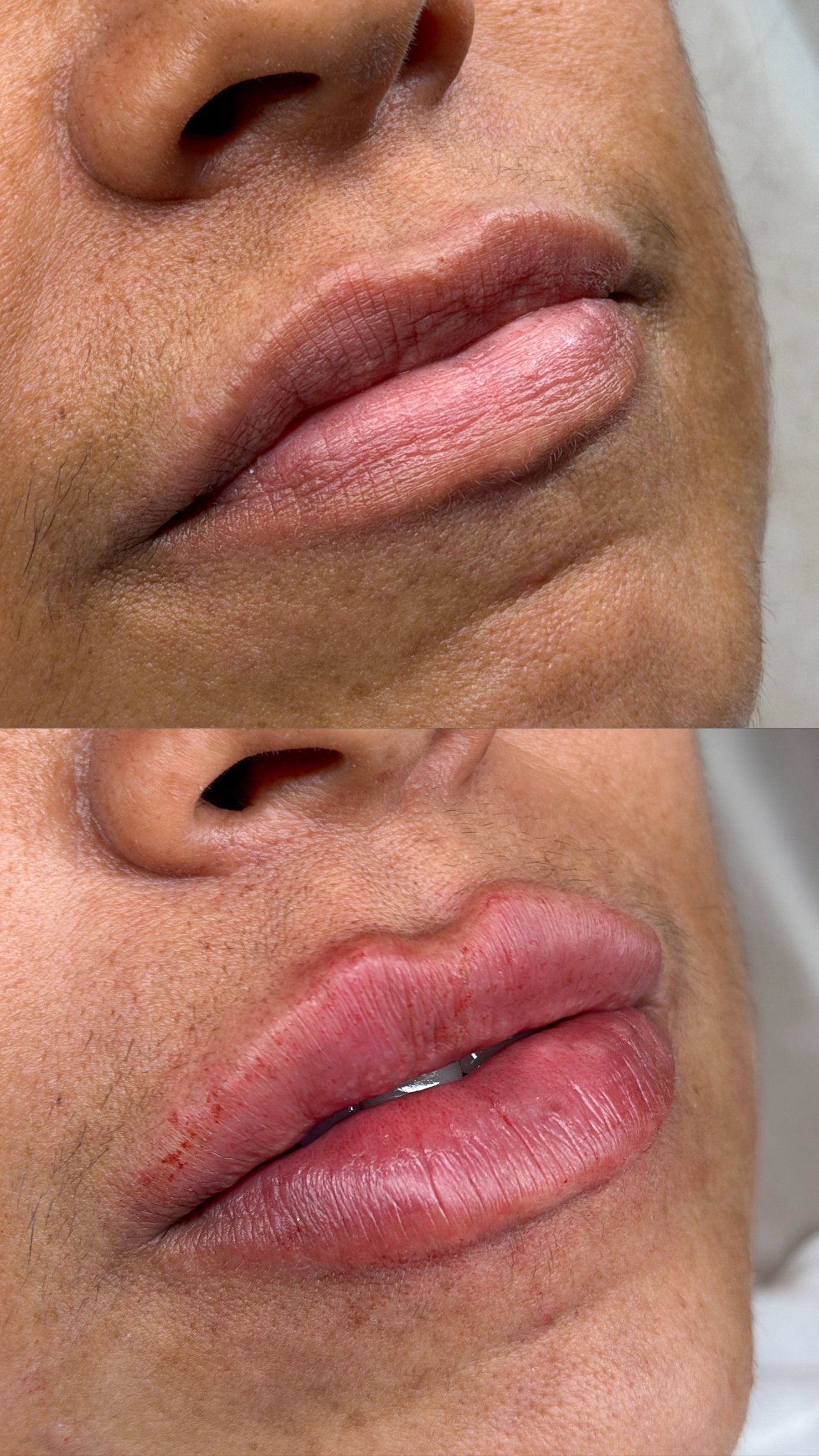 Resultado de preenchimento labial