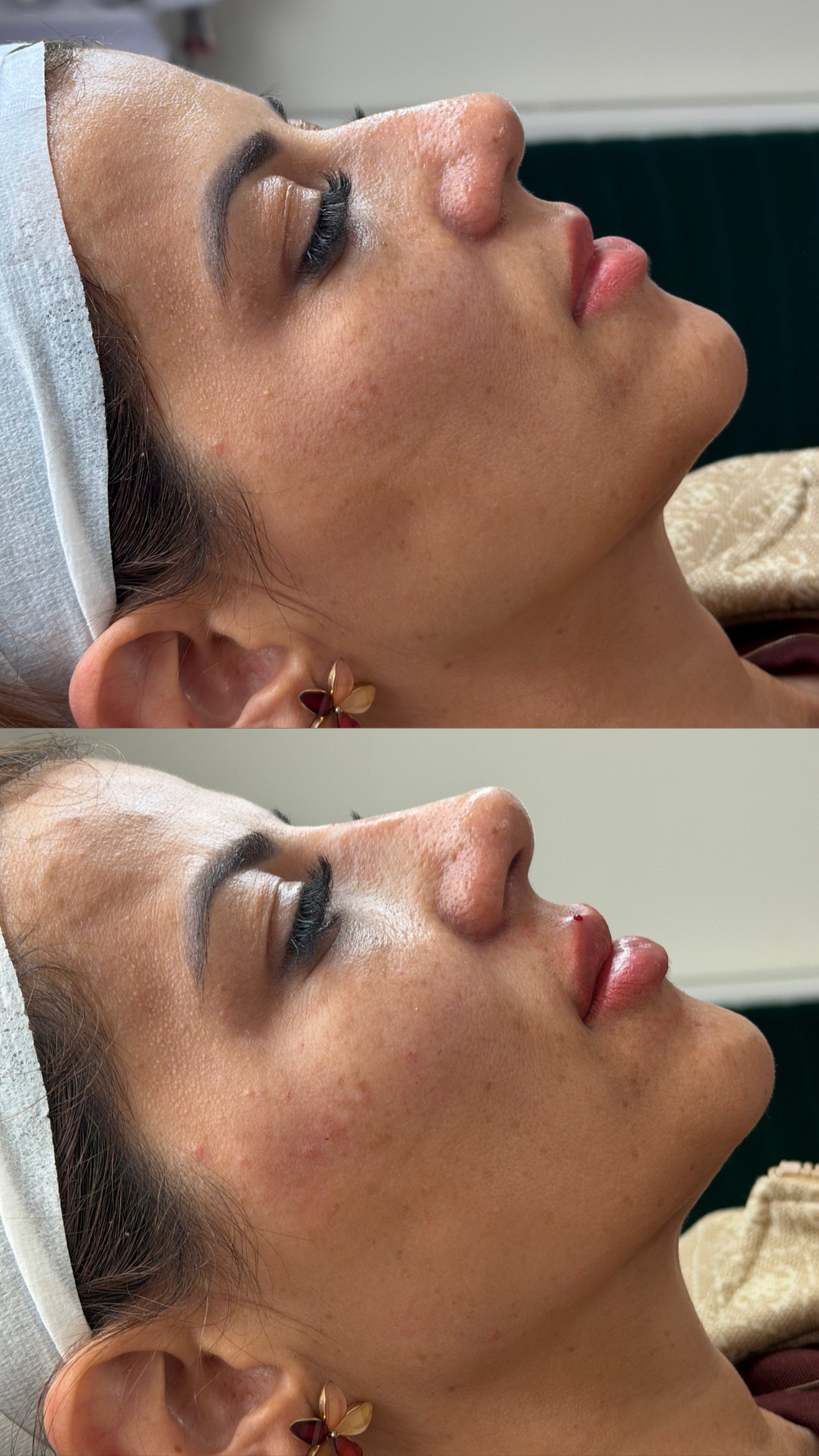Resultado de tratamento facial